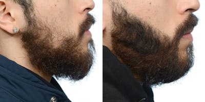 Facial Hair Transplant Before & After Gallery - Patient 551823 - Image 1