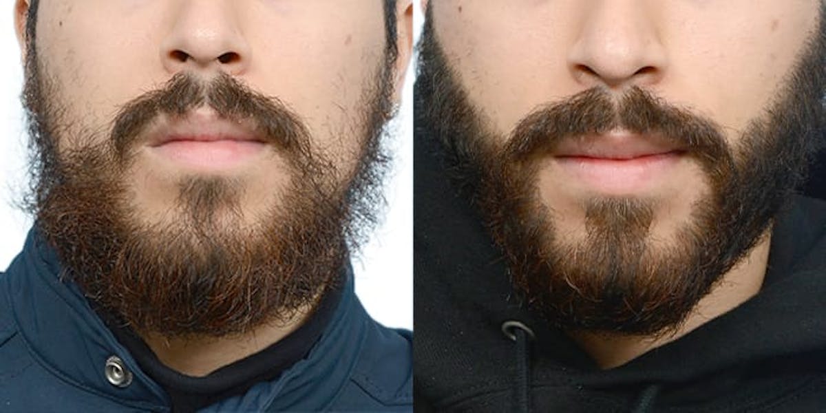 Facial Hair Transplant Before & After Gallery - Patient 551823 - Image 2