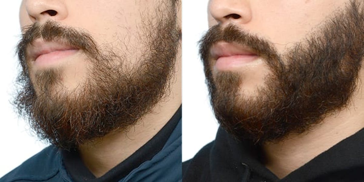 Facial Hair Transplant Before & After Gallery - Patient 551823 - Image 3