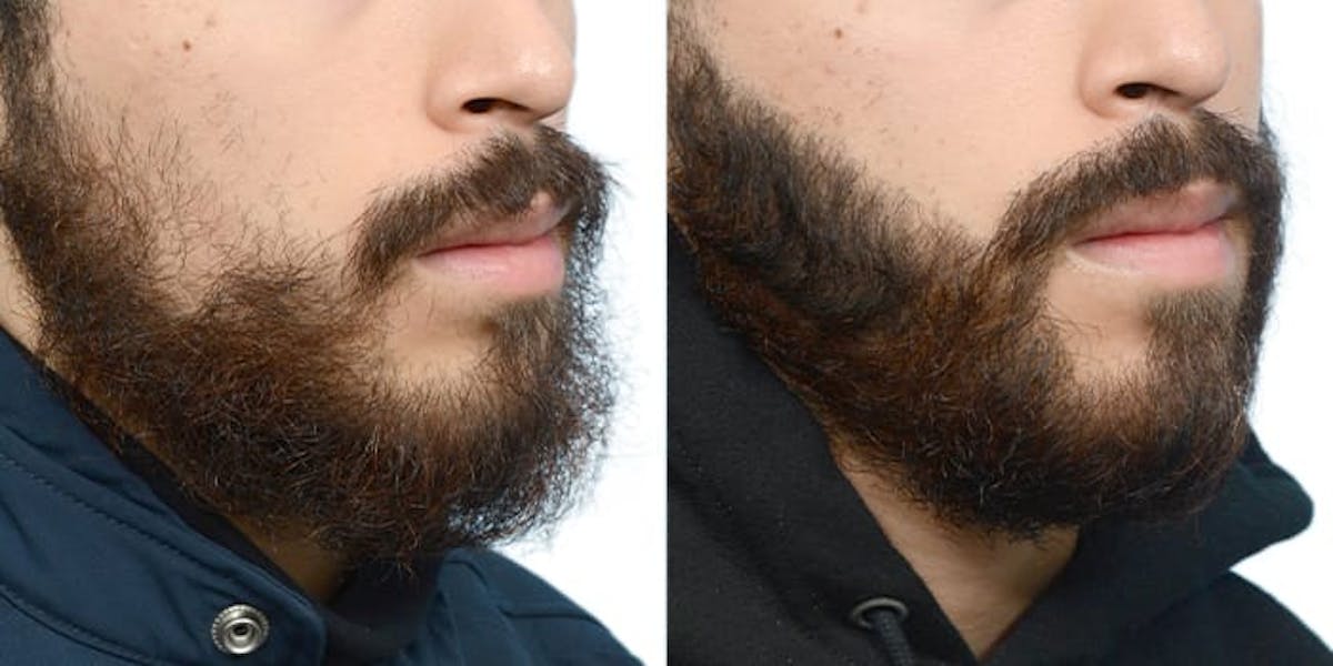 Facial Hair Transplant Before & After Gallery - Patient 551823 - Image 4