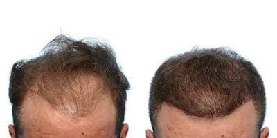 Hair Restoration Before & After Gallery - Patient 102163 - Image 1