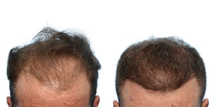 Hair Restoration  Before & After Gallery - Patient 102163 - Image 1