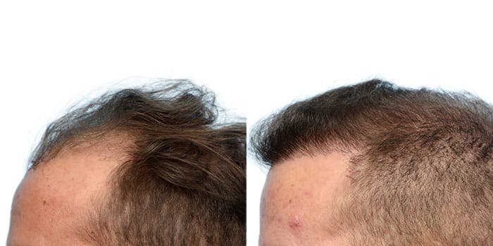 Hair Restoration  Before & After Gallery - Patient 102163 - Image 2