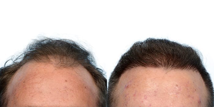 Hair Restoration  Before & After Gallery - Patient 102163 - Image 3