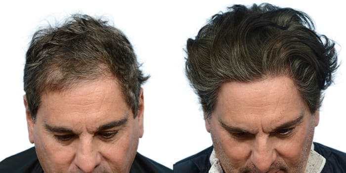 Hair Restoration  Before & After Gallery - Patient 124381 - Image 1