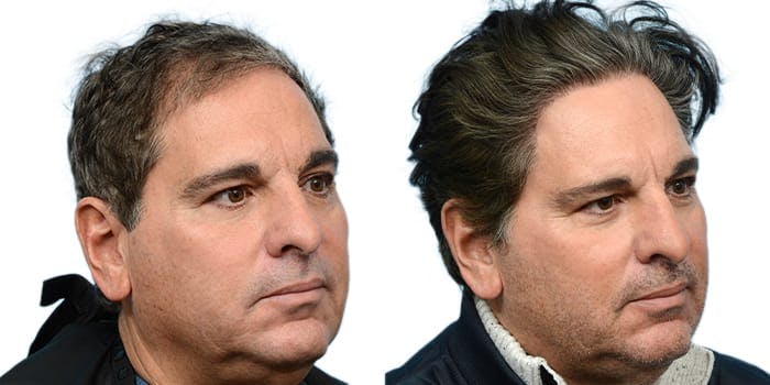 Hair Restoration  Before & After Gallery - Patient 124381 - Image 2