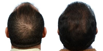 FUE Hair Transplant Before & After Gallery - Patient 234459 - Image 1