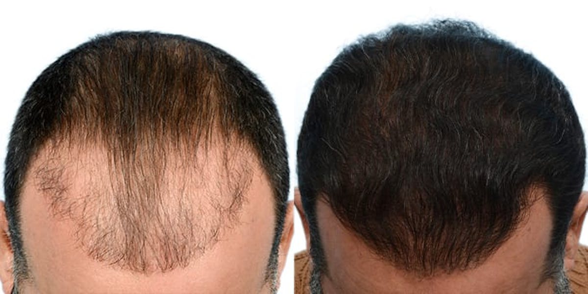Hair Restoration Before & After Gallery - Patient 199702 - Image 2