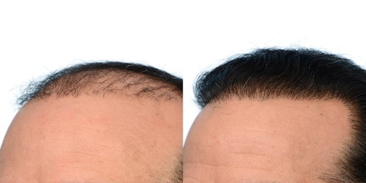 Hair Restoration Before & After Gallery - Patient 199702 - Image 3
