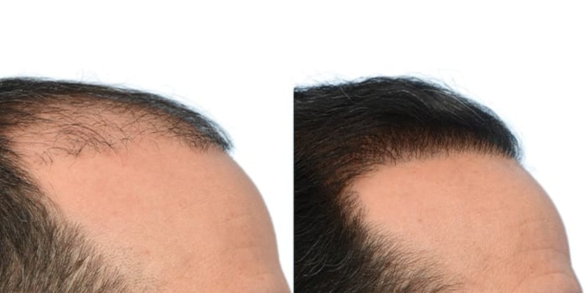 Hair Restoration Before & After Gallery - Patient 199702 - Image 4