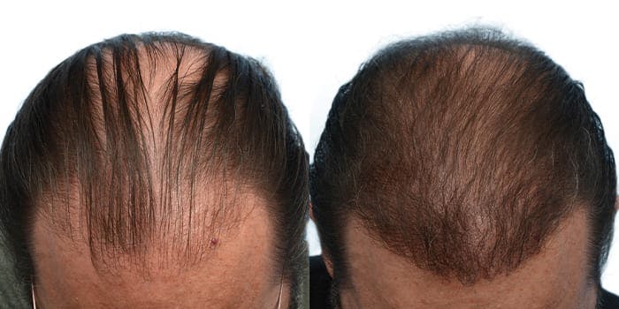 Hair Restoration  Before & After Gallery - Patient 736871 - Image 1