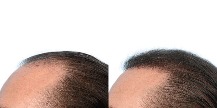 Hair Restoration  Before & After Gallery - Patient 736871 - Image 2