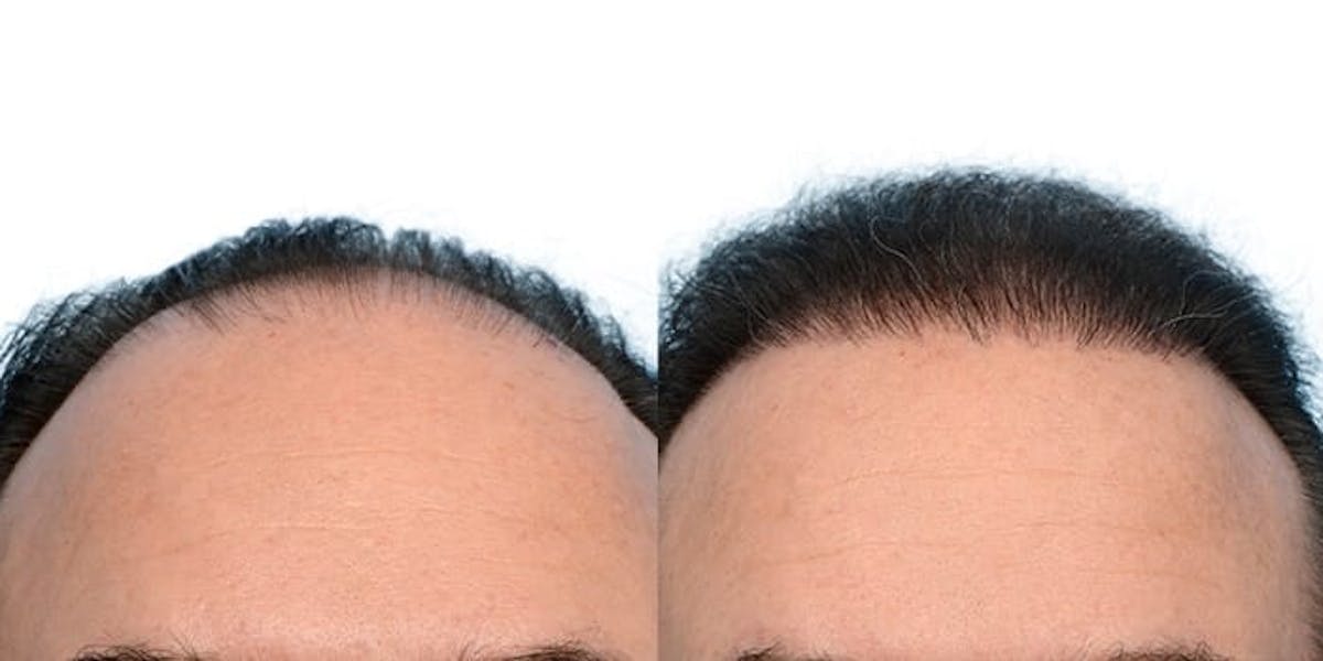 FUE Hair Transplant Before & After Gallery - Patient 127424 - Image 3