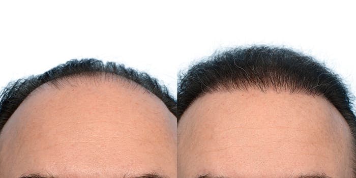 Hair Restoration  Before & After Gallery - Patient 736871 - Image 3