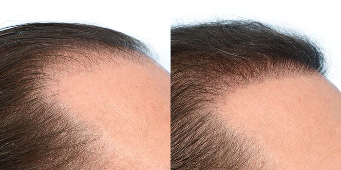 Hair Restoration  Before & After Gallery - Patient 736871 - Image 4