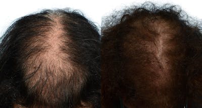 Platelet-Rich-Plasma Before & After Gallery - Patient 270301 - Image 1