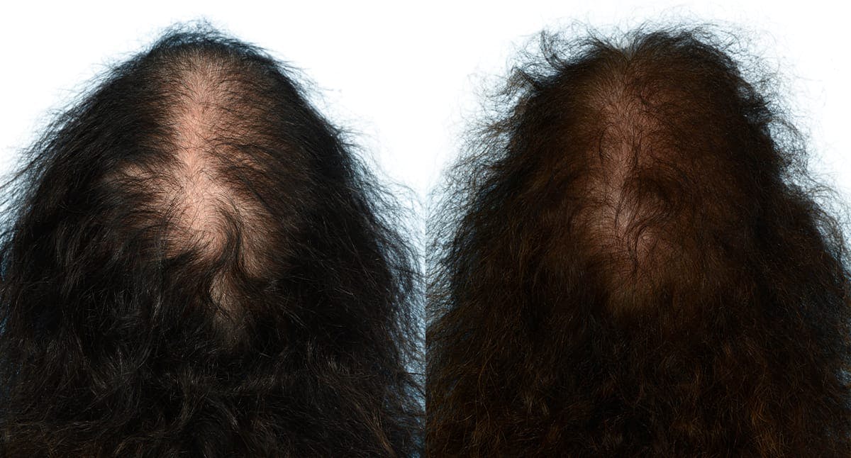 Female Hair Restoration Before & After Gallery - Patient 382536 - Image 2