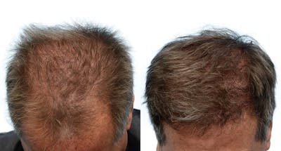 FUE Hair Transplant Before & After Gallery - Patient 281842 - Image 1