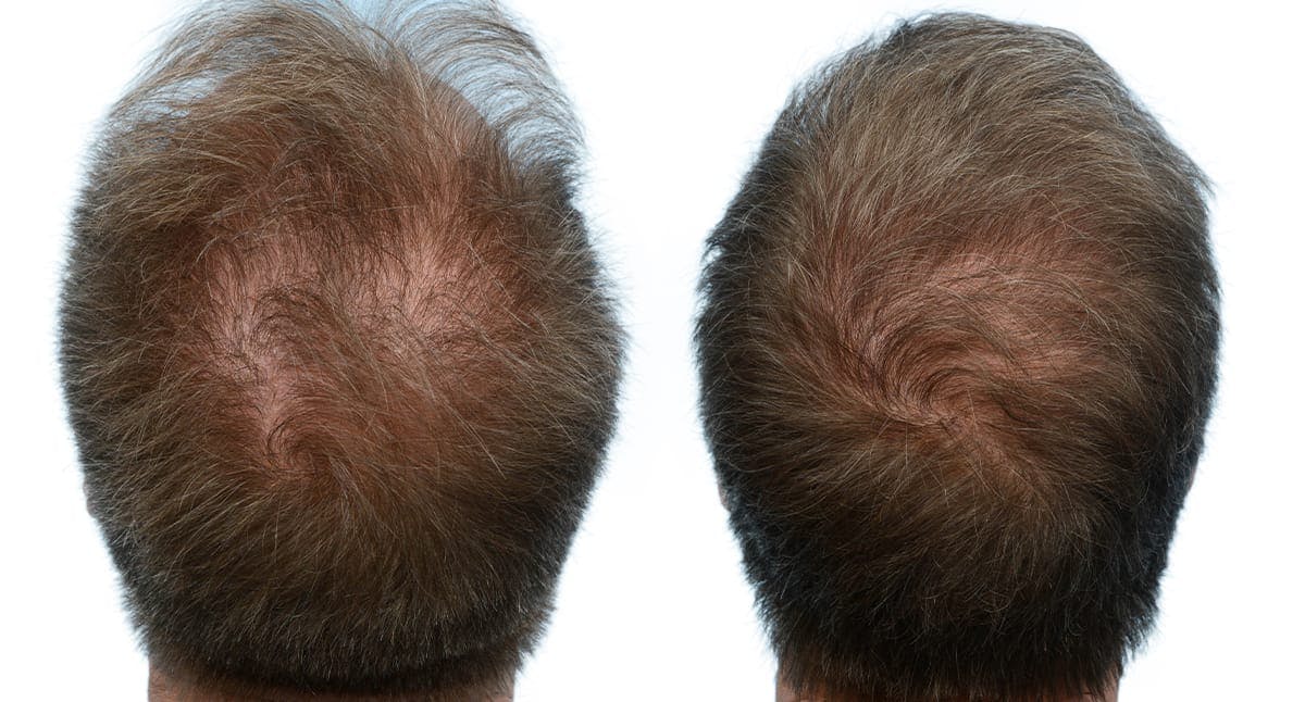 Hair Restoration Before & After Gallery - Patient 226107 - Image 2