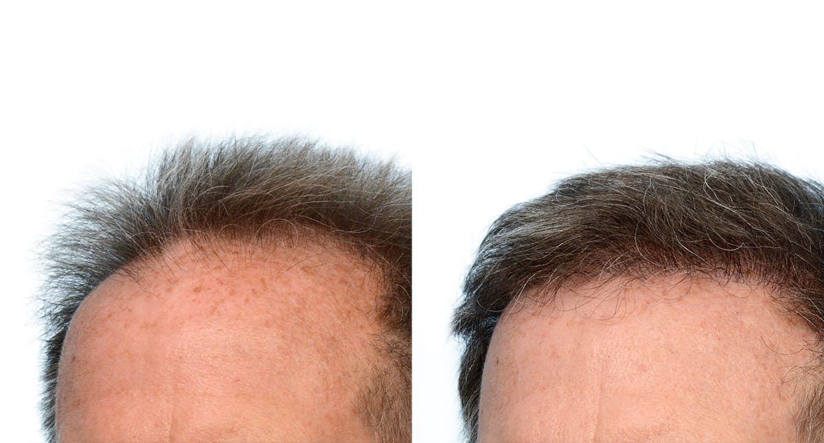 FUE Hair Transplant Before & After Gallery - Patient 281842 - Image 3