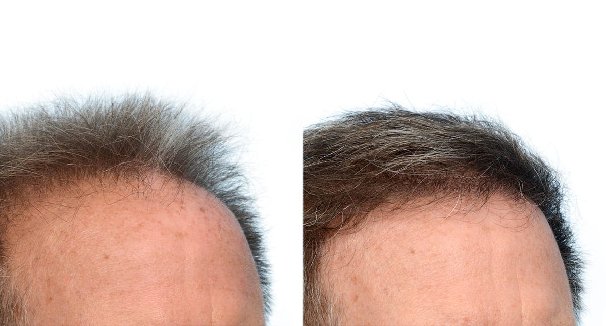 Hair Restoration Before & After Gallery - Patient 226107 - Image 4