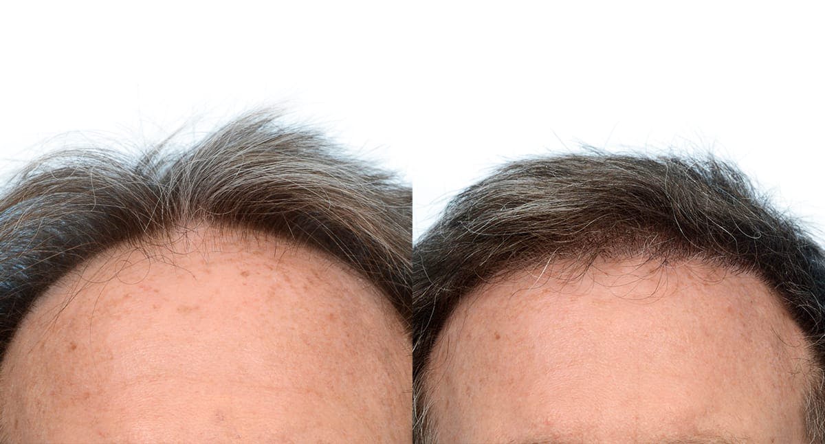 Hair Restoration Before & After Gallery - Patient 226107 - Image 5