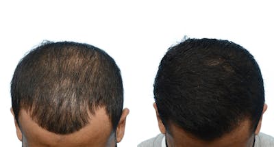 Hair Restoration Before & After Gallery - Patient 141609 - Image 1