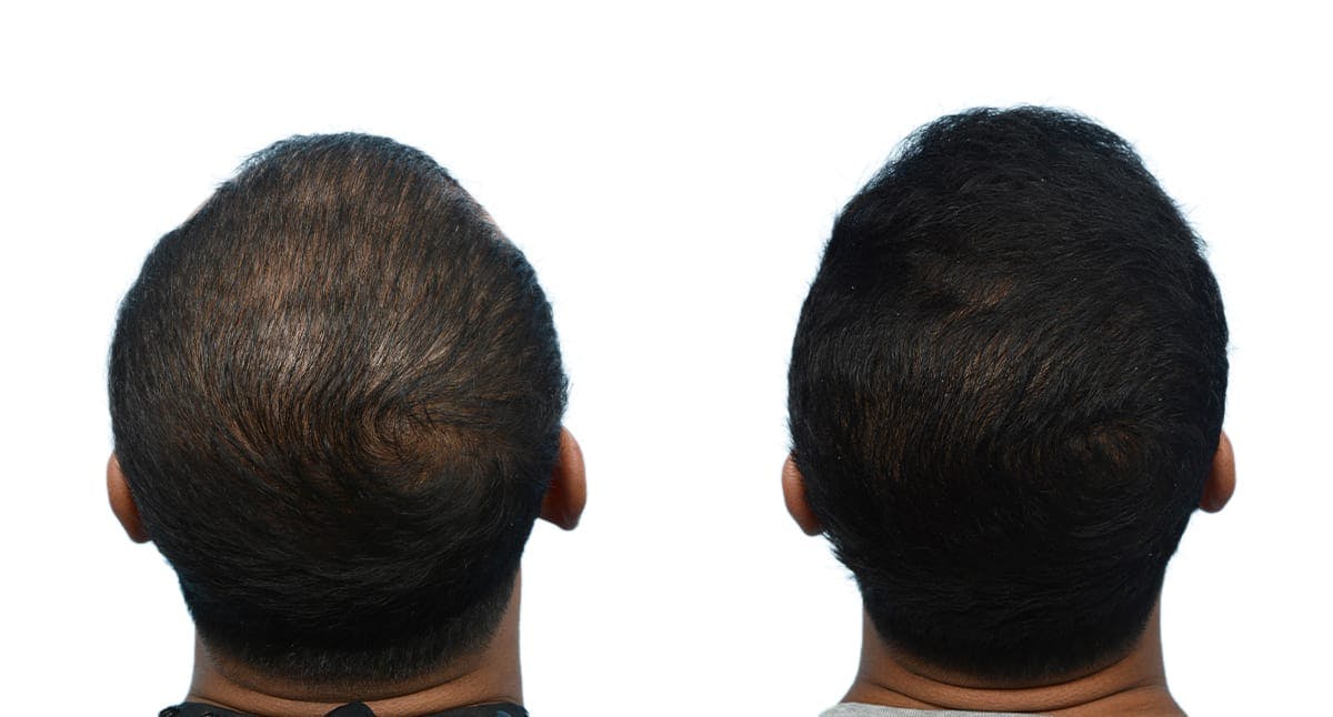 Hair Restoration Before & After Gallery - Patient 141609 - Image 2