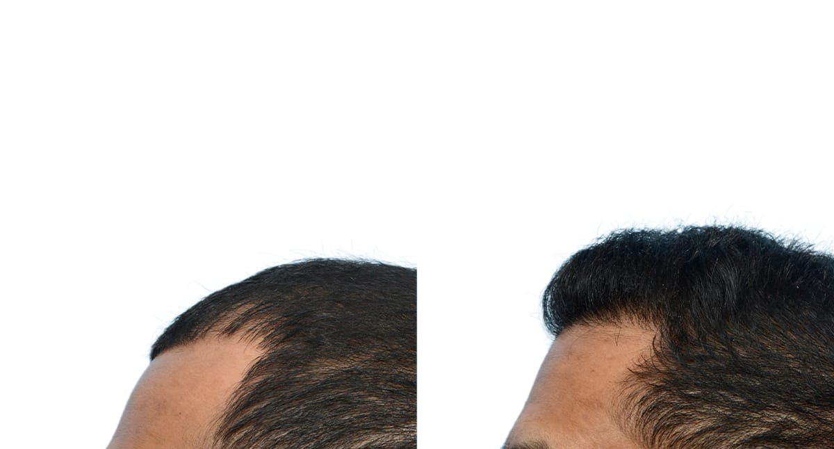 Hair Restoration Before & After Gallery - Patient 141609 - Image 3
