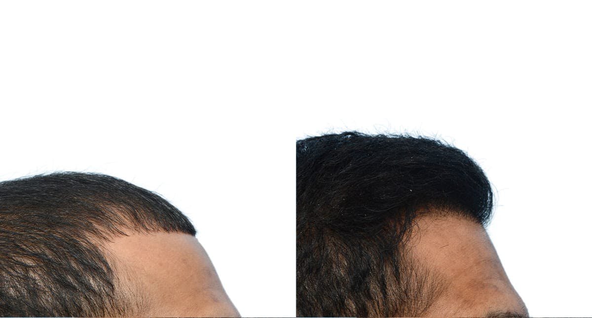 FUE Hair Transplant Before & After Gallery - Patient 919707 - Image 4