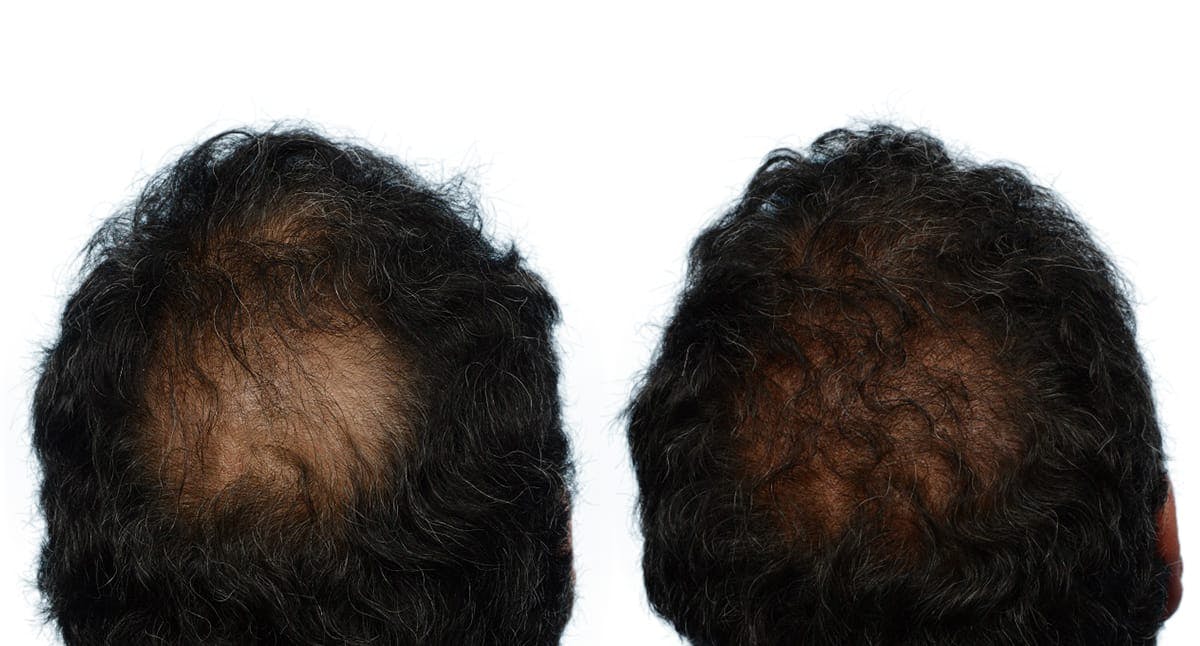 FUE Hair Transplant Before & After Gallery - Patient 579010 - Image 1