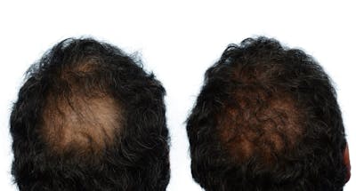 FUE Hair Transplant Before & After Gallery - Patient 579010 - Image 1