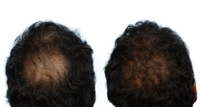 Hair Restoration Before & After Gallery - Patient 443607 - Image 1