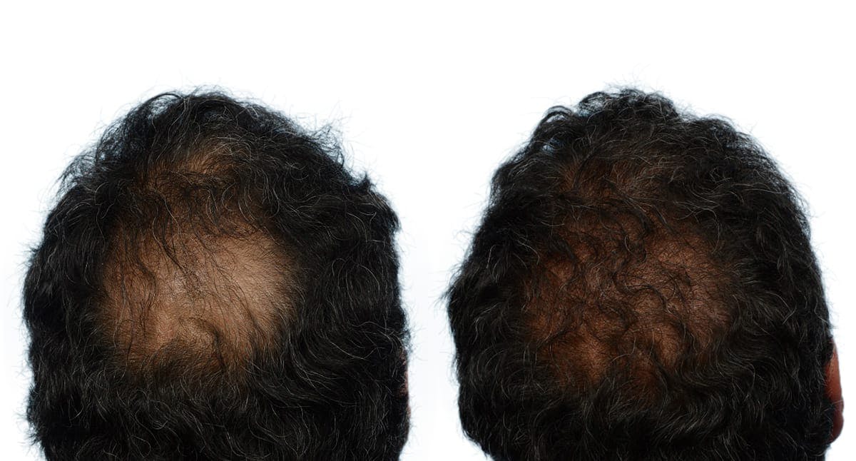 Hair Restoration Before & After Gallery - Patient 443607 - Image 1