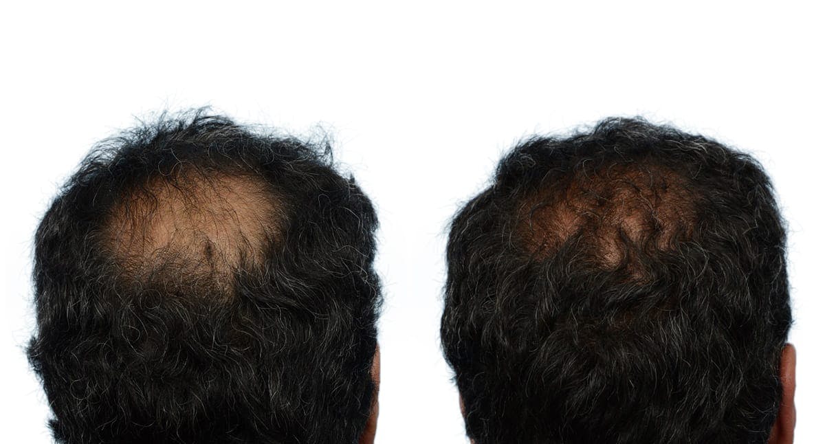 Hair Restoration Before & After Gallery - Patient 443607 - Image 2
