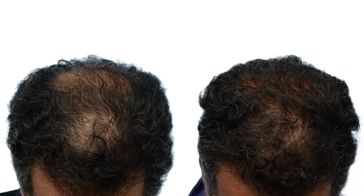 FUE Hair Transplant Before & After Gallery - Patient 579010 - Image 3
