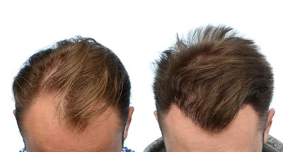 Hair Restoration Before & After Gallery - Patient 423483 - Image 1
