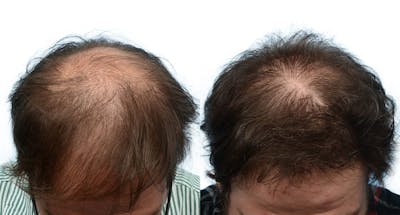 Hair Restoration Before & After Gallery - Patient 136786 - Image 1