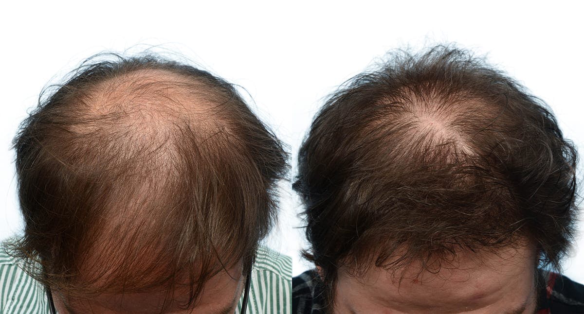 Hair Restoration Before & After Gallery - Patient 136786 - Image 1