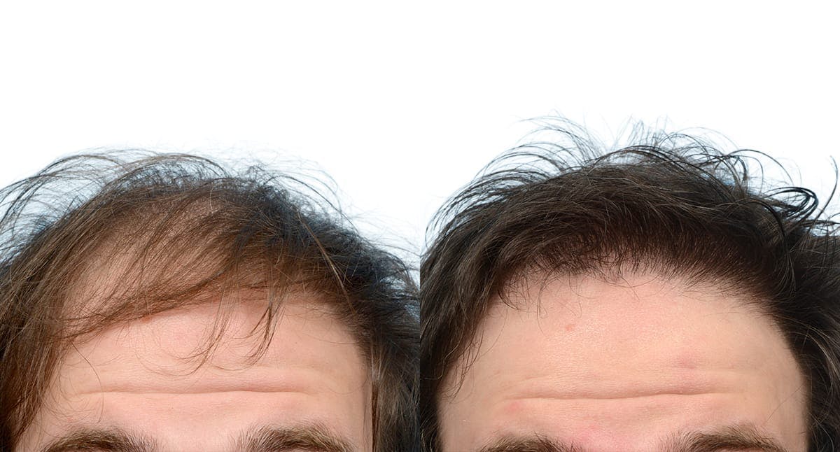 Hair Restoration Before & After Gallery - Patient 136786 - Image 2