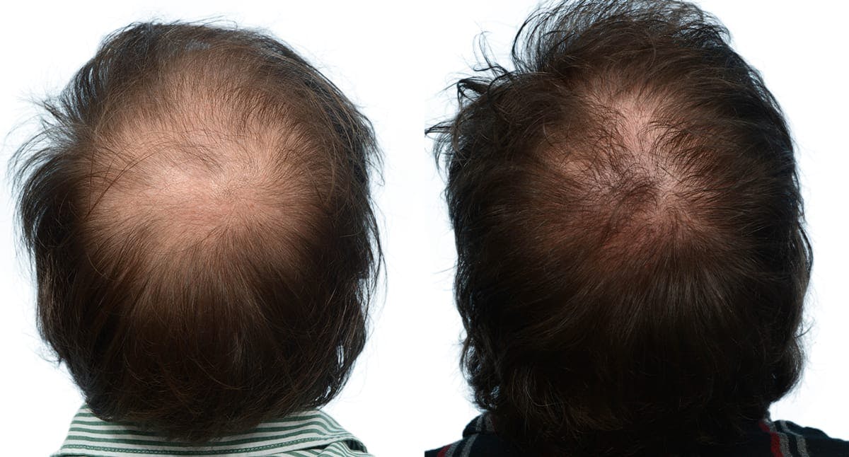 Hair Restoration Before & After Gallery - Patient 136786 - Image 3