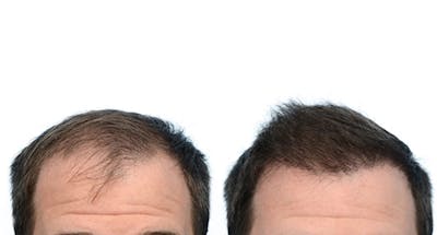 FUE Hair Transplant Before & After Gallery - Patient 301159 - Image 1
