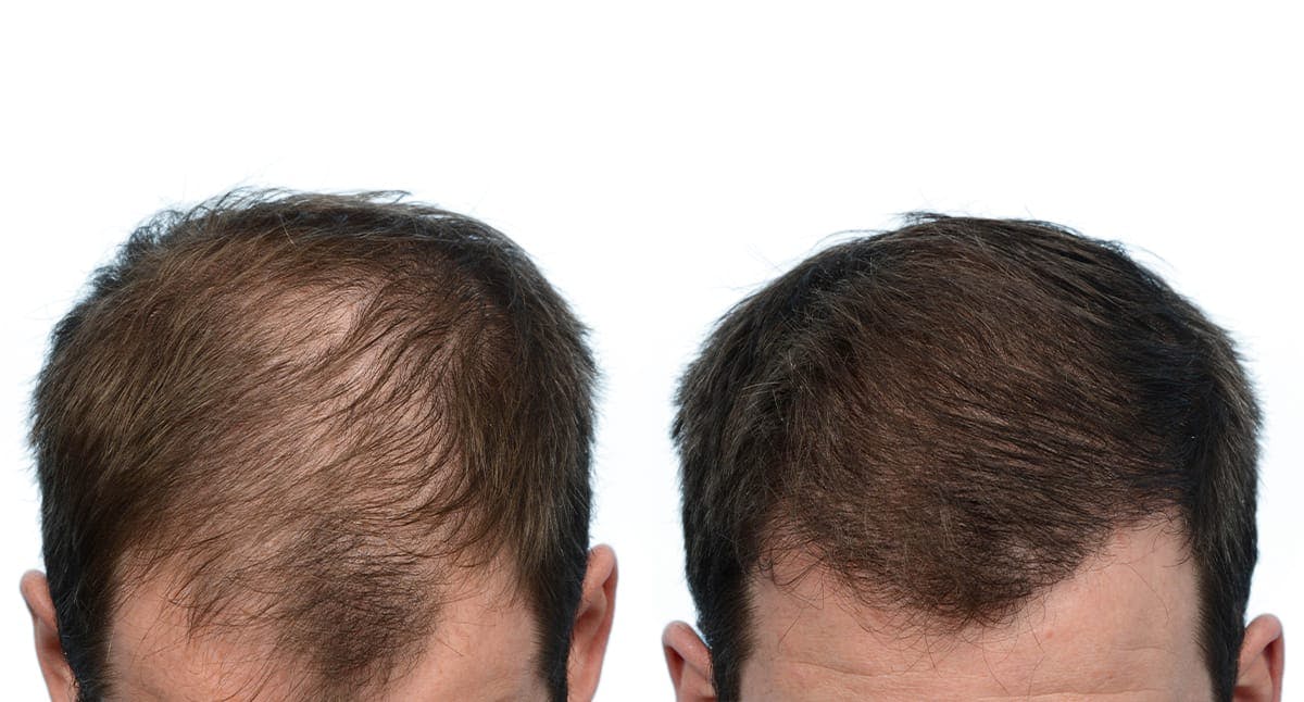 FUE Hair Transplant Before & After Gallery - Patient 301159 - Image 2