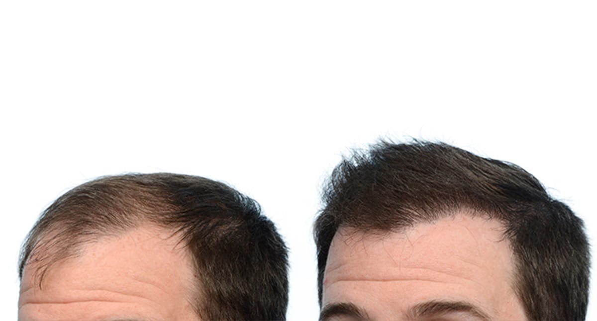 FUE Hair Transplant Before & After Gallery - Patient 301159 - Image 3