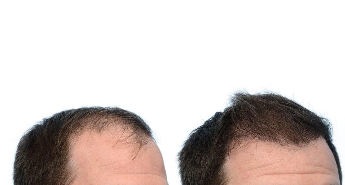 FUE Hair Transplant Before & After Gallery - Patient 301159 - Image 4