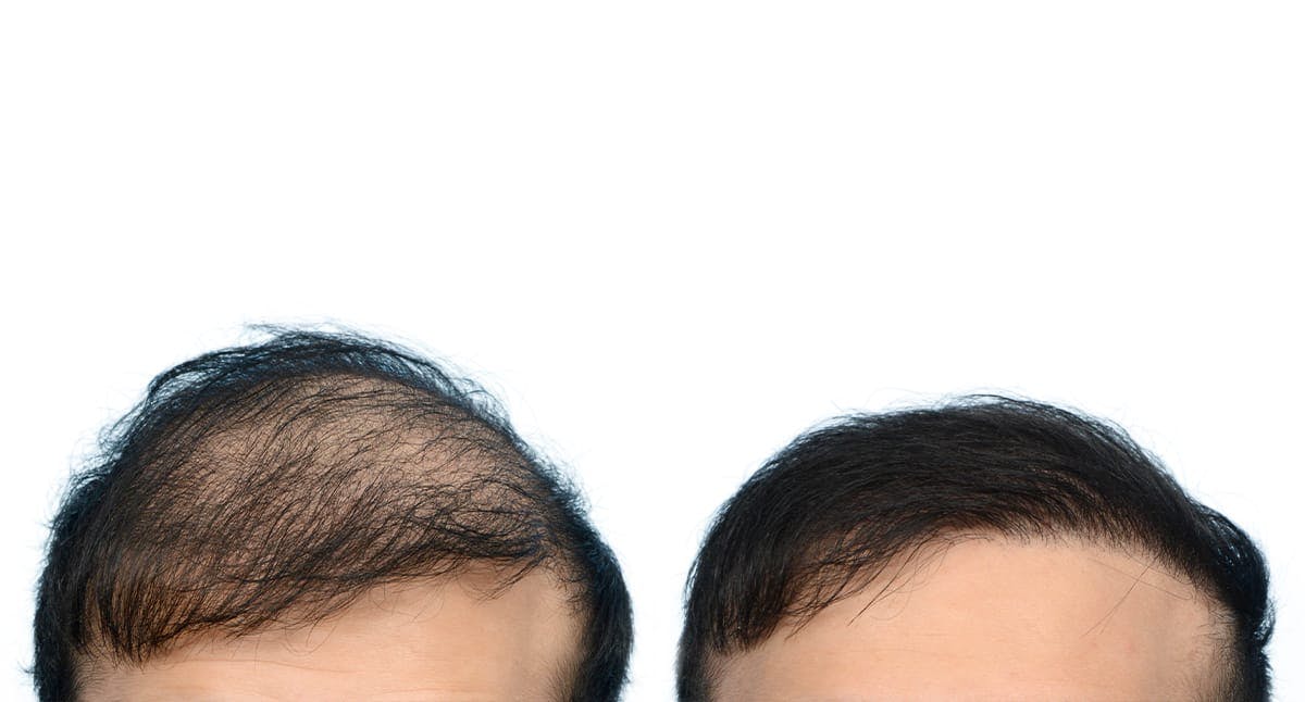 Hair Restoration Before & After Gallery - Patient 414574 - Image 1