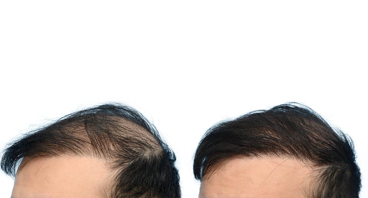 Hair Restoration Before & After Gallery - Patient 414574 - Image 2