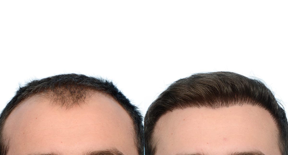 Hair Restoration Before & After Gallery - Patient 181704 - Image 2