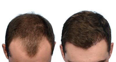 Hair Restoration Before & After Gallery - Patient 181704 - Image 1