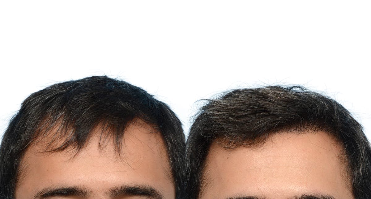 FUE Hair Transplant Before & After Gallery - Patient 206180 - Image 1